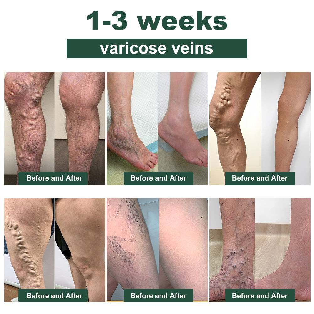 ๐๐๐ง๐๐ญ๐ฎ๐ซ๐โข ๐๐๐ ๐๐๐ง๐จ๐ฆ ๐๐ฅ๐ข๐ฆ๐ฆ๐ข๐ง๐  ๐๐ฒ๐ฆ๐ฉ๐ก๐๐ญ๐ข๐ ๐๐๐ญ๐จ๐ฑ ๐
๐จ๐จ๐ญ ๐๐จ๐๐ค ๐๐๐๐๐ฌ๐ซ- ๐๐๐ฒ๐จ ๐๐ฅ๐ข๐ง๐ข๐ ๐ฑ๐พ๐ผ๐๐๐๐พ๐๐ฝ๐พ๐ฝ(๐๐ซ๐ฎ๐ฌ๐ญ๐๐ ๐๐ฒ ๐จ๐ฏ๐๐ซ ๐ ๐ฆ๐ข๐ฅ๐ฅ๐ข๐จ๐ง ๐๐จ๐ง๐ฌ๐ฎ๐ฆ๐๐ซ๐ฌ ๐ฐ๐จ๐ซ๐ฅ๐๐ฐ๐ข๐๐)